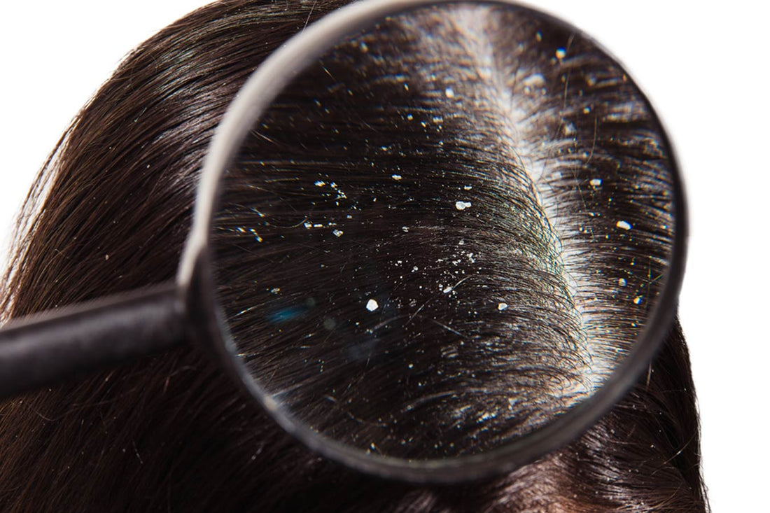 Dandruff_new_1