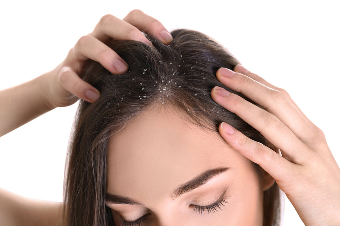 Dandruff_new_2