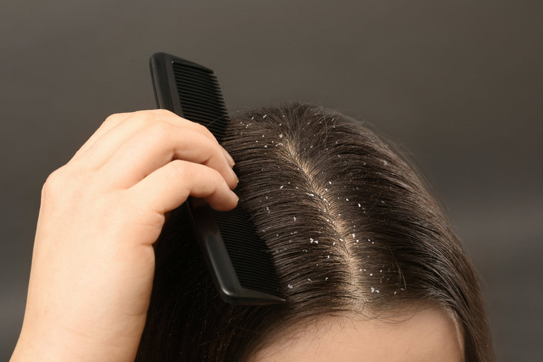 GW-dandruff