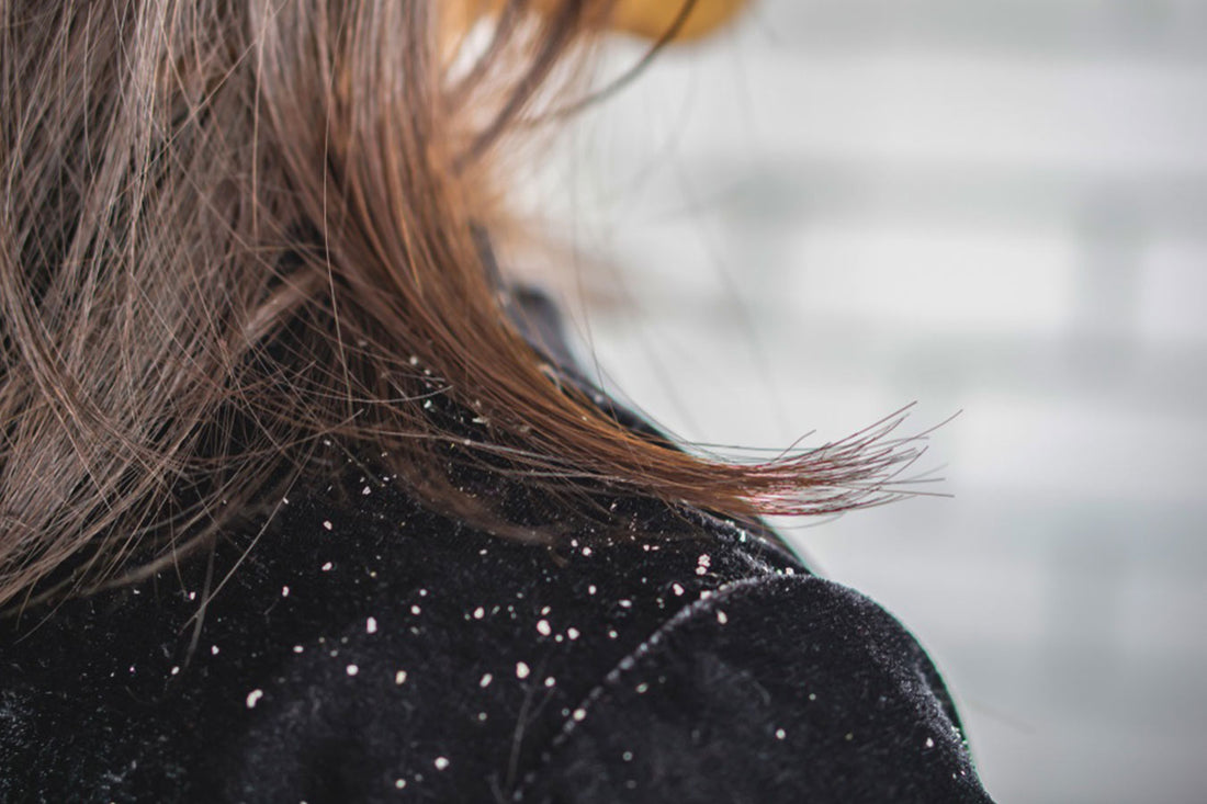 Hair-Dandruff